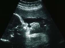 ultrasound of human fetus at 34 weeks and 1 day