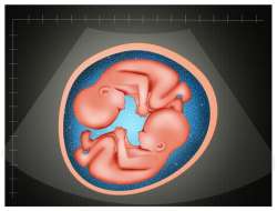 What is Vanishing Twin Syndrome?