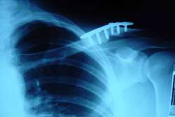 Fractured Collarbone