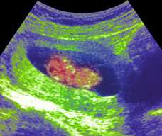 ultrasound of human fetus at 11 weeks and 4 days