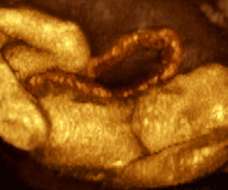 ultrasound of human fetus as 26 weeks and 1 day