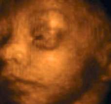 ultrasound of human fetus as 28 weeks and 3 days