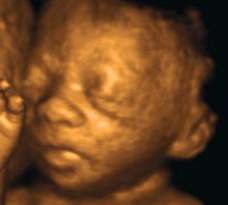ultrasound of human fetus as 28 weeks and 5 days