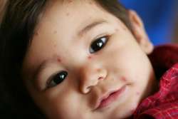 Chickenpox and Rubella During Pregnancy