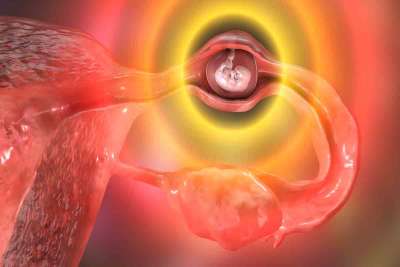 Ectopic Pregnancy 
