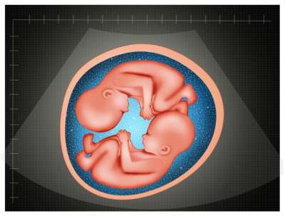 What is Vanishing Twin Syndrome?