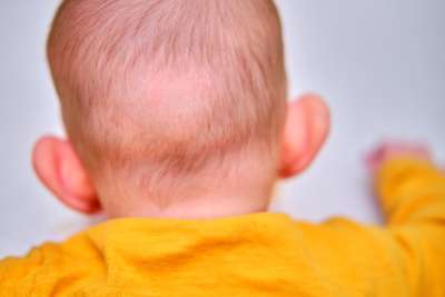 What Is Dolichocephaly in Newborns?