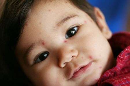 Chickenpox and Rubella During Pregnancy