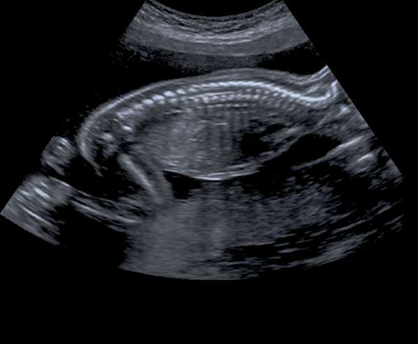 Fetus 25 Weeks 4 Days