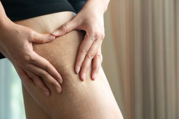 Teen Stretch Marks and Growing Pains: Causes and Treatments