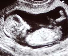 ultrasound of human fetus at 13 weeks exactly