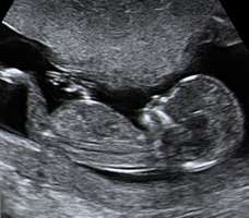 ultrasound of human fetus at 14 weeks exactly