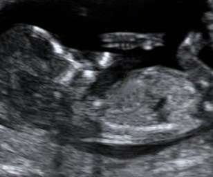 ultrasound of human fetus at 14 weeks and 6 days