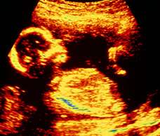 ultrasound of human fetus at 18 weeks and 4 days