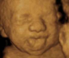 ultrasound of human fetus as 26 weeks and 3 days