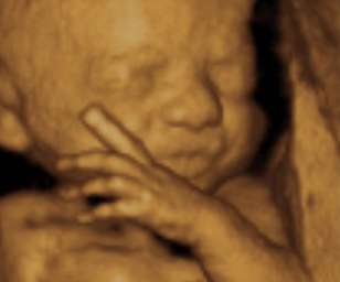 ultrasound of human fetus as 26 weeks and 5 days