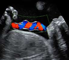 ultrasound of human fetus 32 weeks exactly