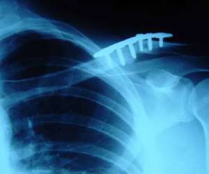 Fractured Collarbone