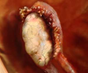 ovary at the end of fallopian tube ready to release egg