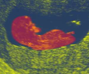 ultrasound of human fetus at 13 weeks and 6 days