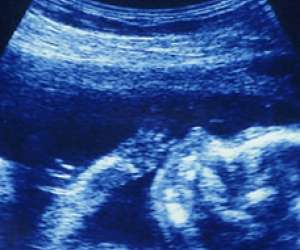 ultrasound of human fetus at 17 weeks and 3 days