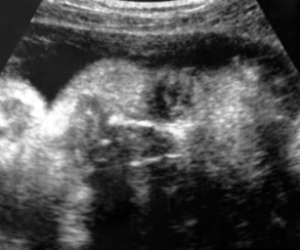ultrasound of human fetus 31 weeks and 4 days