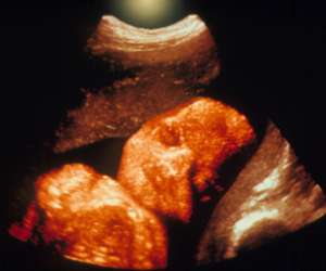 ultrasound of human fetus 31 weeks and 6 days