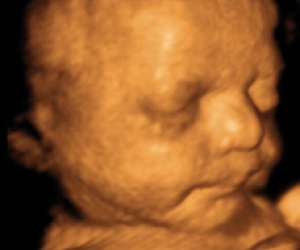 ultrasound of human fetus at 33 weeks and 3 days