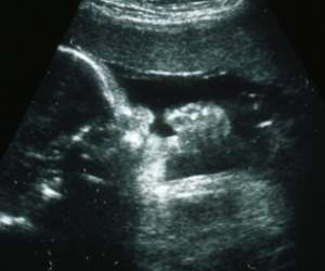 ultrasound of human fetus at 34 weeks and 4 days