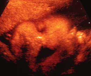 ultrasound of human fetus 39 weeks and 6 days
